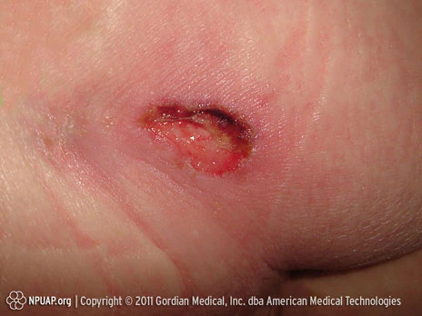 Κατηγορία/Στάδιο ΙΙΙ έλκους από κατάκλιση: Ολικού πάχους απώλεια δέρματος (ορατός λιπώδης ιστός)