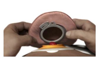 <h4>2 τεμαχίων, με μηχανικό κούμπωμα</h4>
Ο σάκος κουμπώνει σε μία βάση με πλαστικό κούμπωμα.