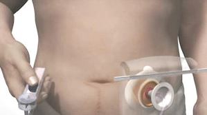 Υποκλυσμός